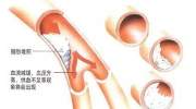 高血脂的病理病因、常见症状及调理建议
