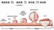 藏在肚子里的定时炸弹—大肠息肉！