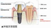深圳缺牙的小伙伴医生为什么推荐种牙？