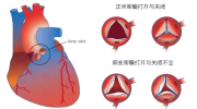 风湿性心脏病的症状，治疗，康复病例