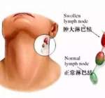 淋巴癌早期症状有哪些 日常生活如何预防淋巴疾病