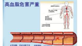 为你说说“糖尿病与高血脂”！