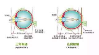 长期戴眼镜会使眼睛凸吗？