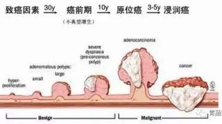 藏在肚子里的定时炸弹—大肠息肉！