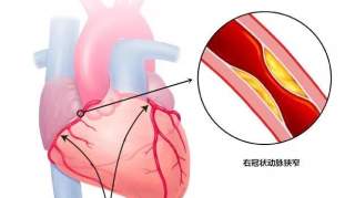 闭塞的右冠状动脉通了，解除纠缠老人20年的“心病”