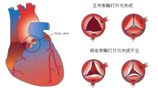 风湿性心脏病的症状，治疗，康复病例