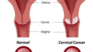 辟谣！私生活不检点才会患上宫颈癌，是真的吗？今天就告诉你答案