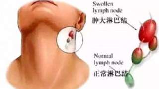 淋巴癌早期症状有哪些 日常生活如何预防淋巴疾病