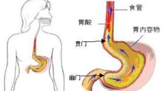 食道炎是什么症状，食道痒但不痛！