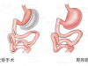 减重手术会不会复胖 关键要看手术后的健康管理