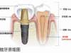 深圳缺牙的小伙伴医生为什么推荐种牙？