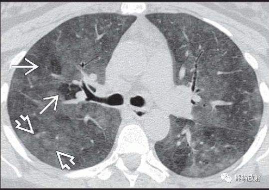 过敏性肺炎（急性、亚急性）丨CT表现、诊断要点