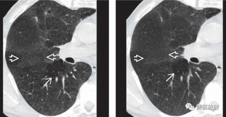 过敏性肺炎（急性、亚急性）丨CT表现、诊断要点