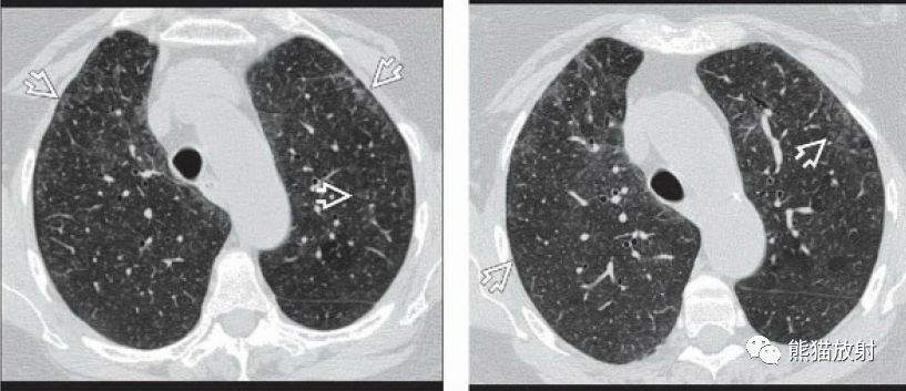 过敏性肺炎（急性、亚急性）丨CT表现、诊断要点