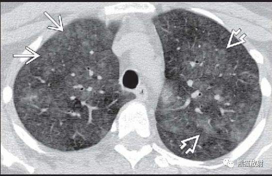 过敏性肺炎（急性、亚急性）丨CT表现、诊断要点