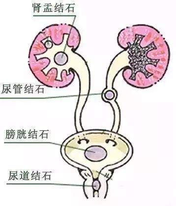 喝茶会不会导致肾结石？医生告诉你