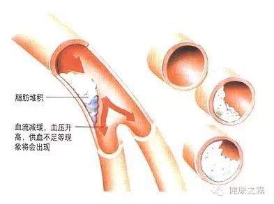 高血脂的病理病因、常见症状及调理建议