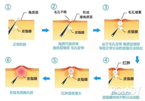 光滑少女肌的秘密 鸡皮肤再见！