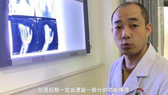 兰州一男子和老婆吵架后砍断自己4根手指：绝不能打老婆