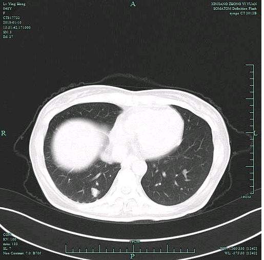 【医疗快讯】普外三科：多脏器联合切除术 为患者坚守健康