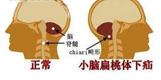 这些症状出现是脊髓在报警，严重可瘫痪！