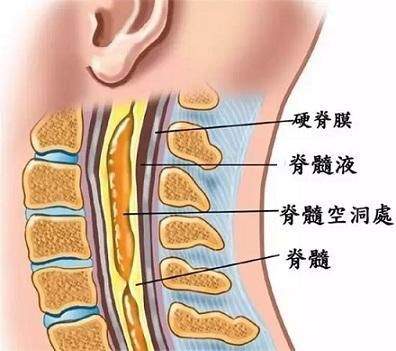 这些症状出现是脊髓在报警，严重可瘫痪！