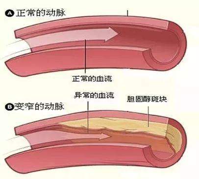 八旬老人腿疼20天后被截肢……腿脚酸痛、走不远，不一定是骨头出了问题