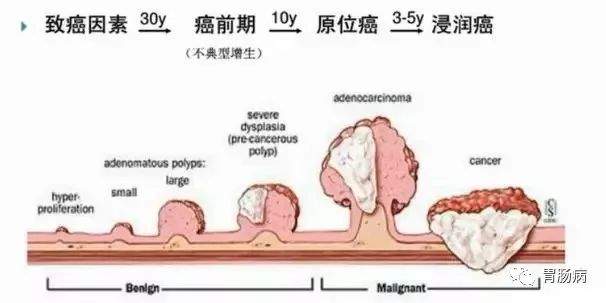 藏在肚子里的定时炸弹—大肠息肉！