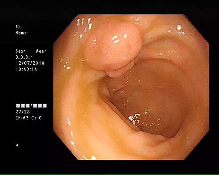 藏在肚子里的定时炸弹—大肠息肉！