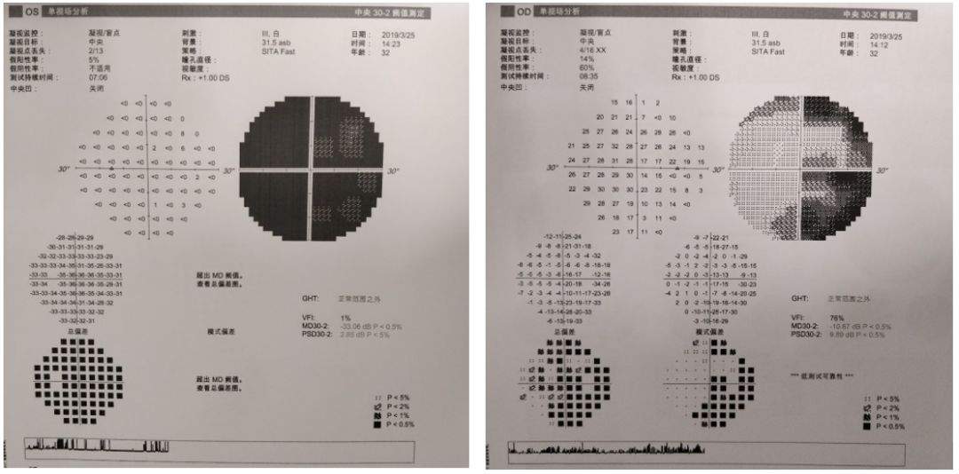 陈亮教授：内镜辅助鞍结节脑膜瘤切除术