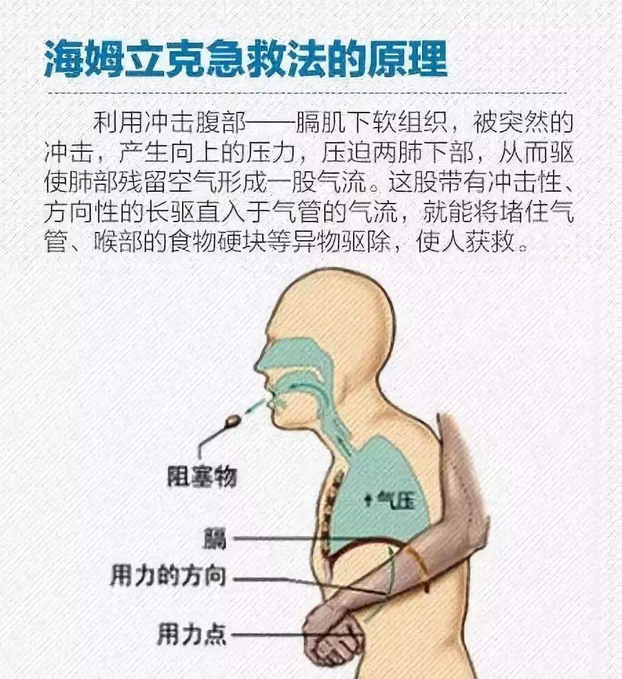 比心肺复苏还重要的海姆立克急救法，护士们赶紧练起来吧！