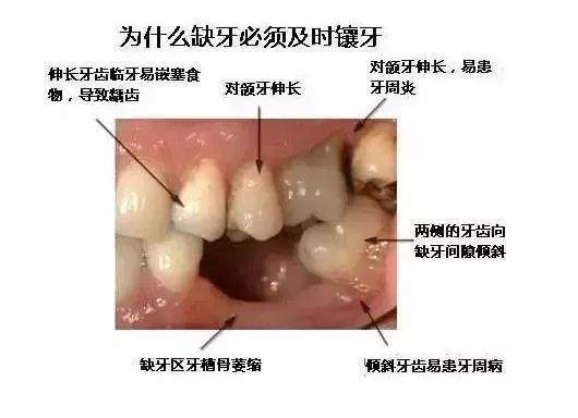 缺牙不补，威胁整个口腔！