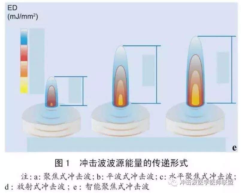 ESWT体外冲击波治疗有什么好处？