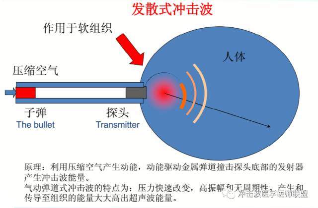 ESWT体外冲击波治疗有什么好处？