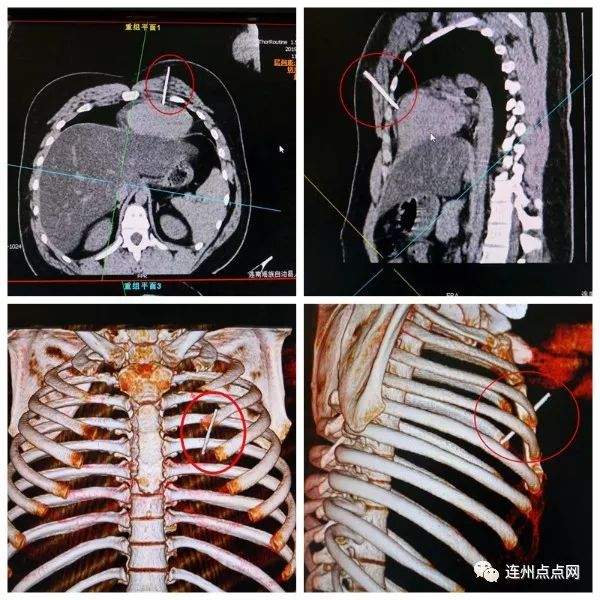 连南这位患者好凶险：睡觉时不慎被5厘米绣花针刺进胸部