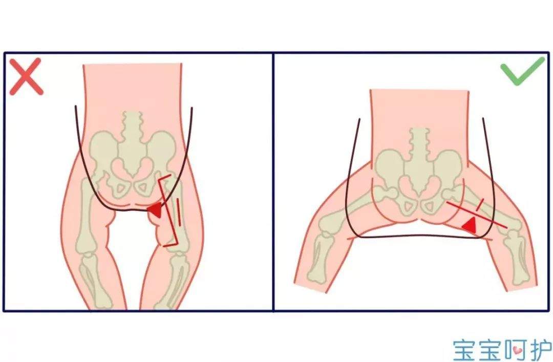 注意宝宝双腿的这些表现，可能是得了这种骨骼病