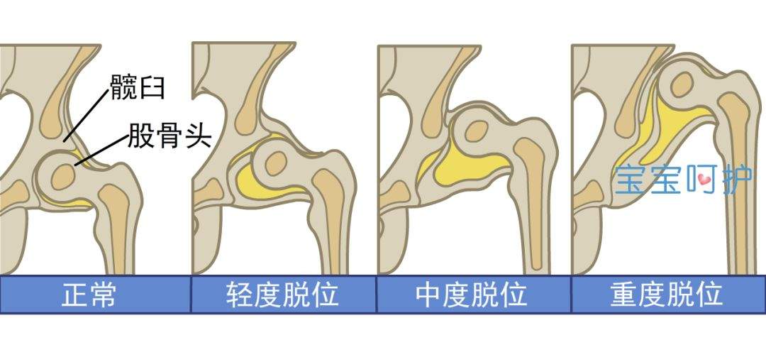 注意宝宝双腿的这些表现，可能是得了这种骨骼病