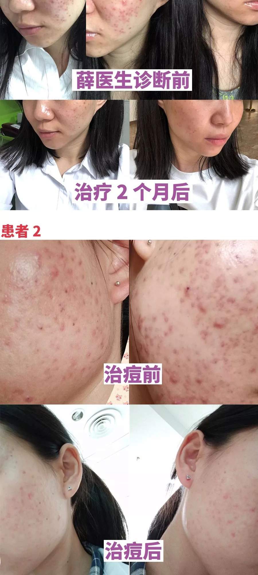 痘痘反复治不好？这套皮肤专家的治痘攻略，你肯定用得上