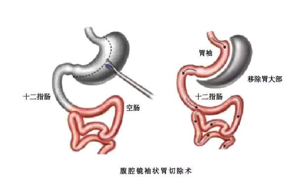 身材肥胖若出现这4信号说明你的健康正被侵蚀