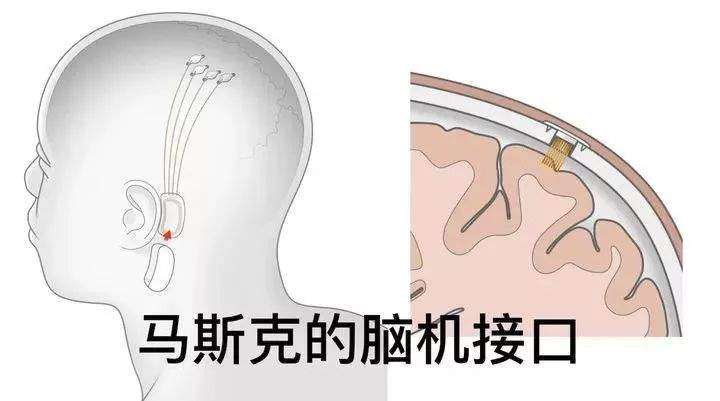 马斯克的脑机接口能如愿以偿吗？