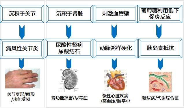 无症状高尿酸血症要不要治疗?