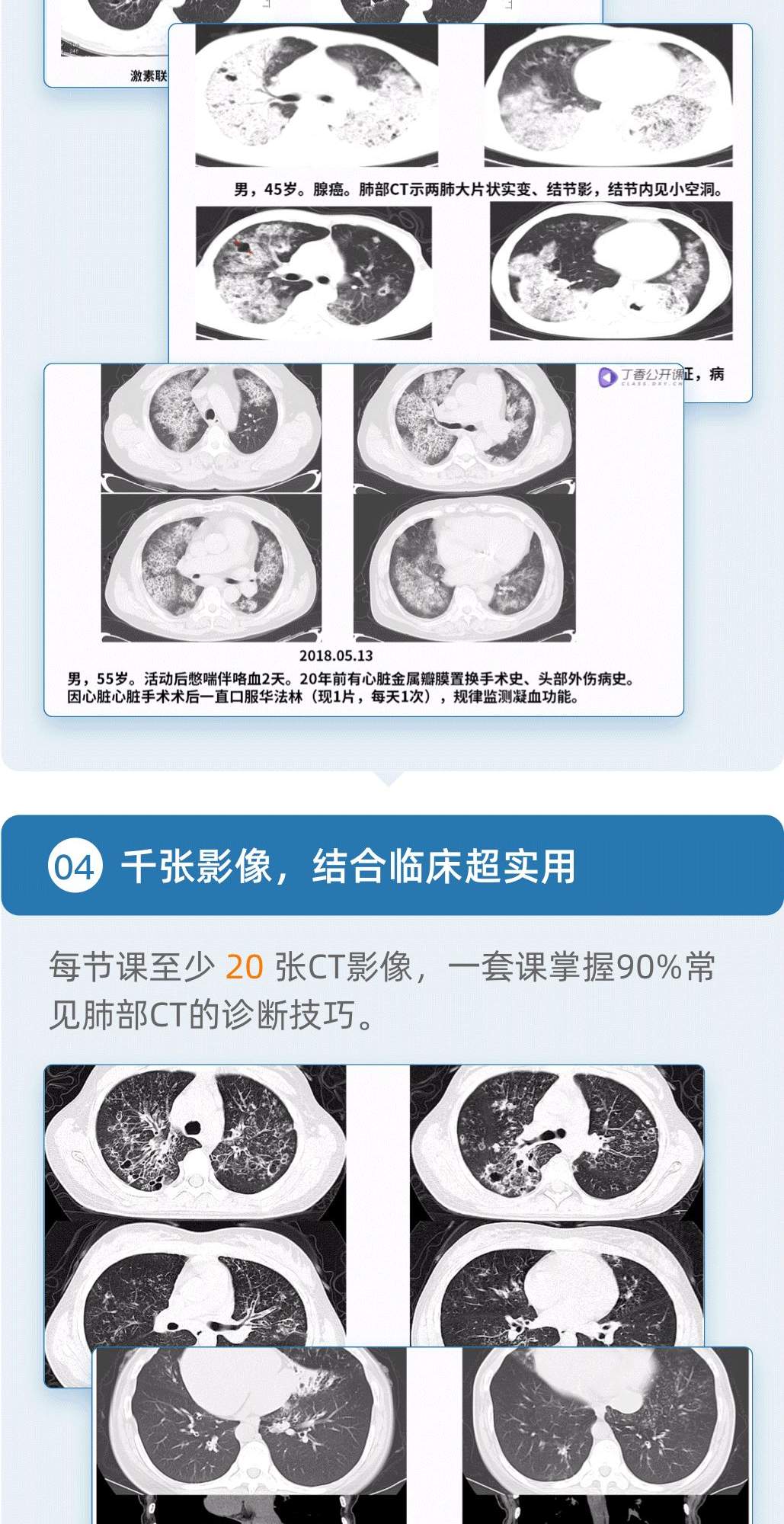 15种常见征象详解，一起秒杀肺部CT！