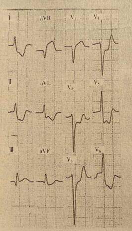 辨识心电图，高危心梗速诊断！