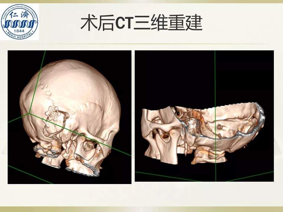 张晓华教授团队：听神经瘤切除顺序制定-仁济策略