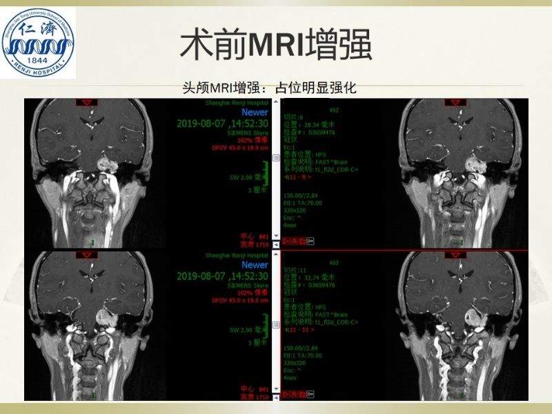 张晓华教授团队：听神经瘤切除顺序制定-仁济策略