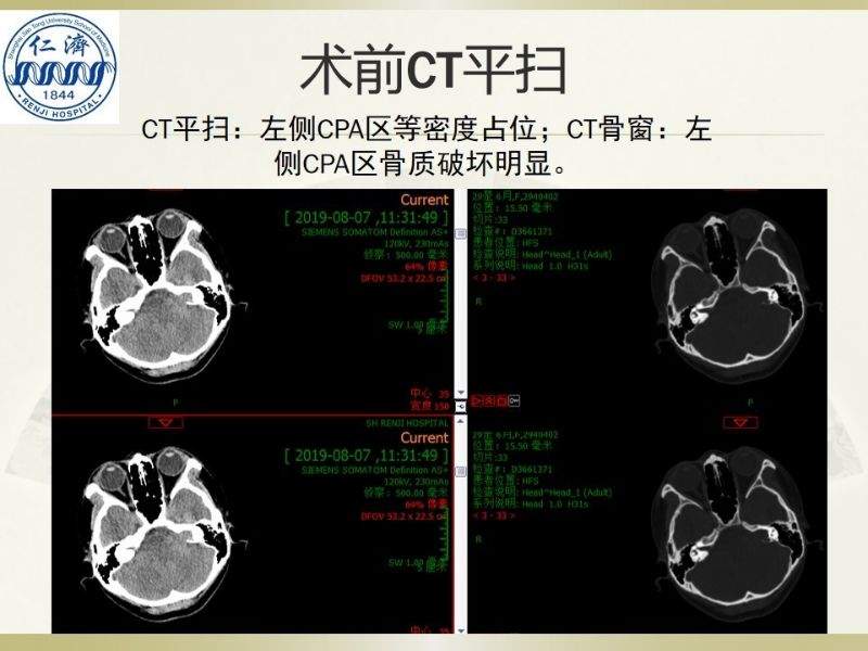 张晓华教授团队：听神经瘤切除顺序制定-仁济策略