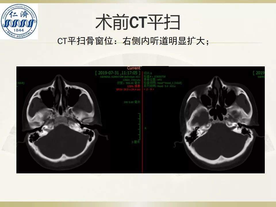 张晓华教授团队：听神经瘤切除顺序制定-仁济策略