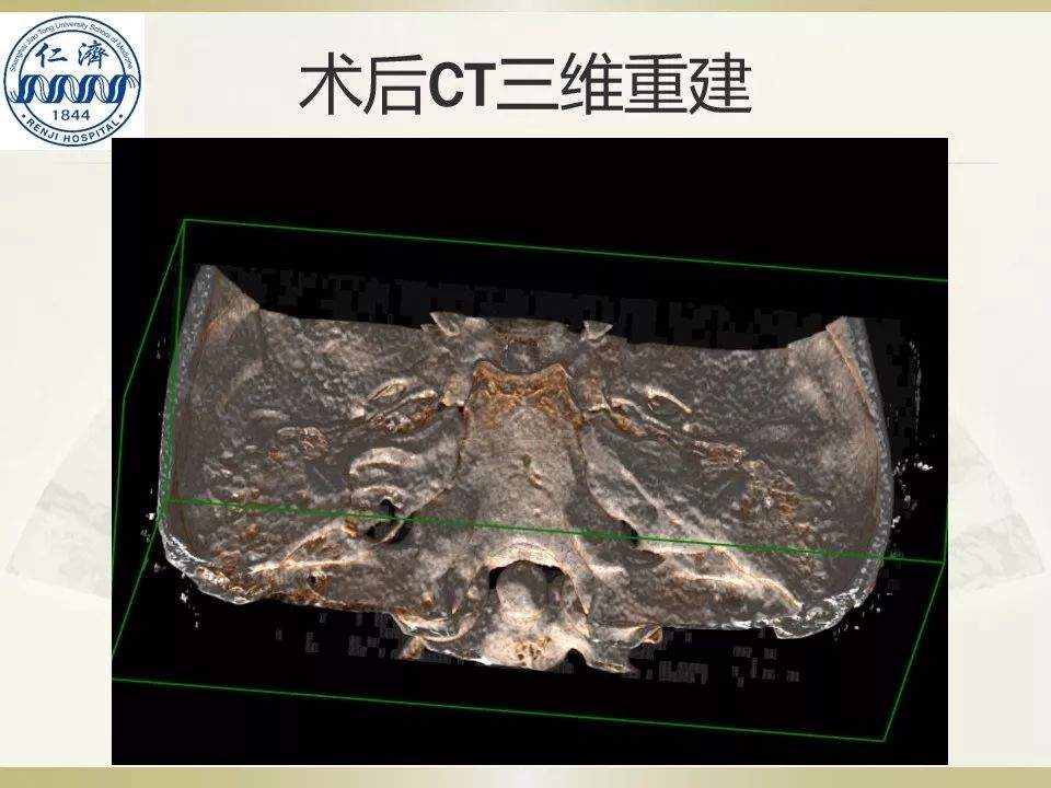 张晓华教授团队：听神经瘤切除顺序制定-仁济策略