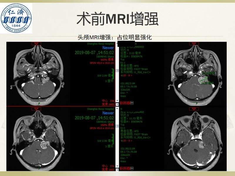 张晓华教授团队：听神经瘤切除顺序制定-仁济策略