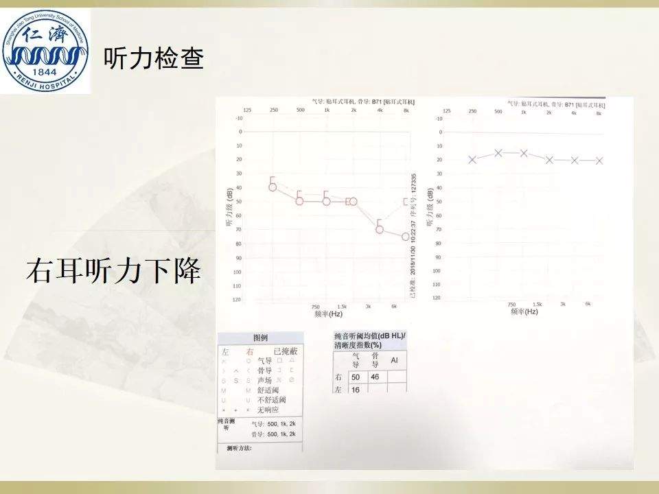 张晓华教授团队：听神经瘤切除顺序制定-仁济策略